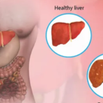 Causes of Fatty Liver Disease